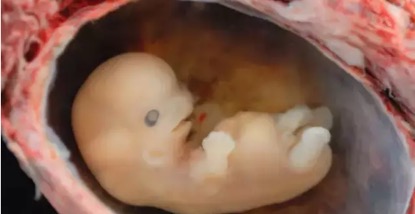 早期胚胎停育，多少人的痛！